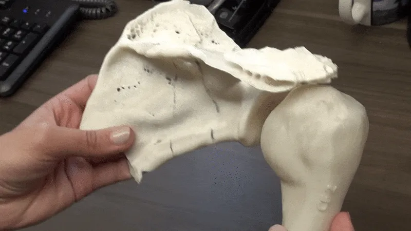 How Baptist Health is using 3D printing to revolutionize shoulder replacement surgery